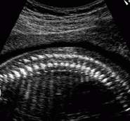 22 haftal�k gebelik