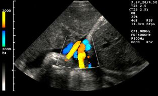 Doppler ultrasonografi