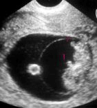 8 haftal�k gebelik