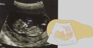 14 haftal�k gebelik