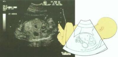 20 haftal�k gebelik